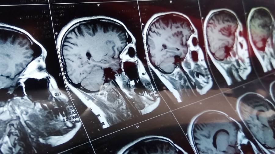 L'università del Regno Unito sviluppa un dispositivo per ripristinare il senso del tatto nei pazienti con ictus