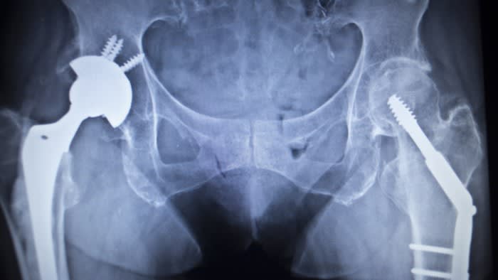 Aumento delle sostituzioni dell'anca finanziate privatamente, poiché i pazienti evitano gli arretrati del SSN, dimostra uno studio